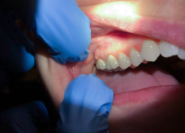 Best Emergency Dentist for Lost Fillings or Crowns in Monmouth, OR
