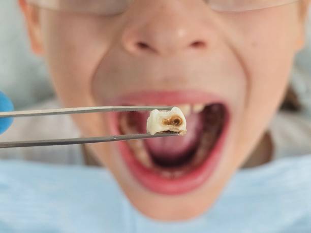 Best Broken or Cracked Tooth Emergency Dentist in Monmouth, OR